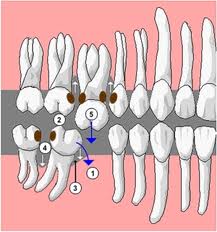 Ne pas remplacer des dents absentes n'est pas sans conséquences