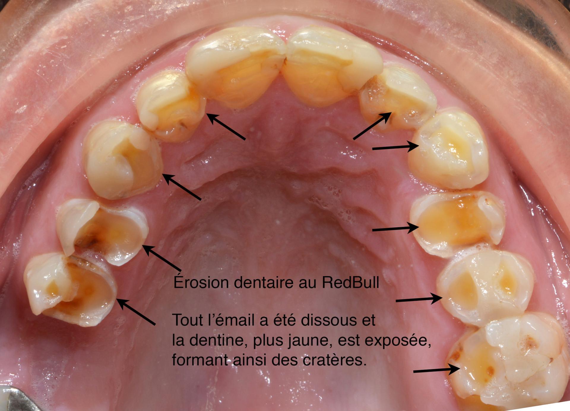 Erosions chimiques sodas